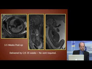 Prenatal Management of CPAMs: Lung Lesions