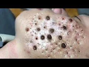 cystic acne blackhead whitehead removal | Relaxing Spa Acne Treatment