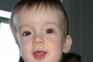 Measurements Matter in Craniosynostosis | Neuroscience