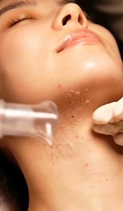 ASMR Under-Chin Blackhead Removal | Deep Jaw Curve Vacuum Extraction in 4K #asmr #blackheadsremoval