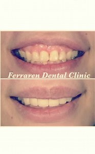 High smile line correction with gum contouring and zirconia crowns殺 #gumcontouring #zirconiacrown | Ferraren Dental Clinics | Facebook