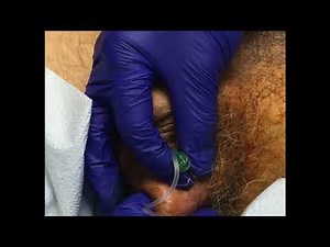 Office Based Management of Hydroceles: Aspiration and Sclerotherapy - Dr. Laurence Levine