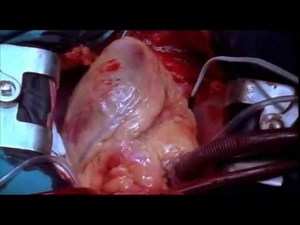 Live Beating Heart and Heart Surgery Video By Dr. Prodigious