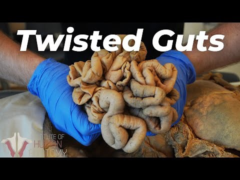 The EXCRUCIATING Anatomy of Bowel Obstructions