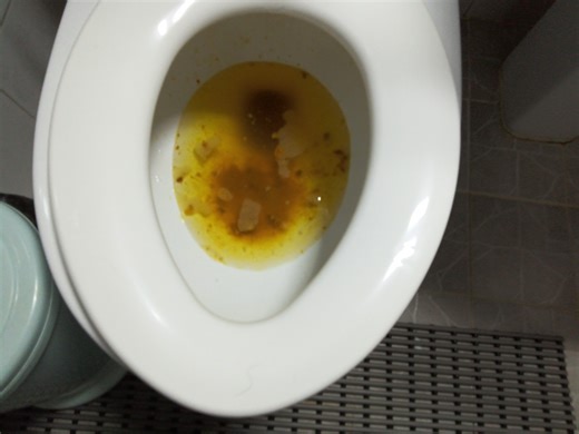 Explosion diarrhea toilet - video 4