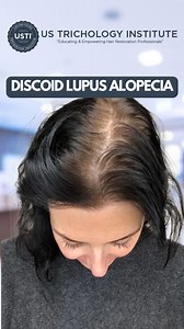 Understanding Discoid Lupus Alopecia . . . #HairLoss #Alopecia #Baldness #HairGrowth #HairRestoration #HairTransplant #ThinningHair #HairTreatment #HairCare #Balding | United States Trichology Institute