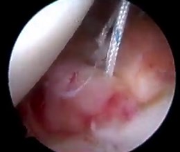4.2K views · 113 reactions | Reparación de ligamentos en hombro mediante artroscopia #Shoulder | Dr Adrian N. Sirio | Facebook