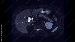 MRCP or Magnetic resonance cholangiopancreatography axial view showing visualize the biliary and pancreatic ducts .