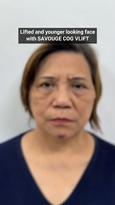 13K views · 18 reactions | Did you know that COG face thread lifts...