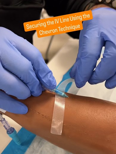 Essential Chevron Technique for IV Security