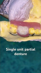 Single unit partial denture 😬😬😬#apexdental #dentistry #partialdenture #orthodontist #splittooth