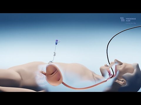 Placement of a Freka® PEG tube for percutaneous intragastric long-term nutrition and decompression