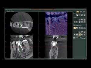 Morita i Dixel - Dental TI Presents Endo with the J Morita R100 CBCT and i Dixel Software