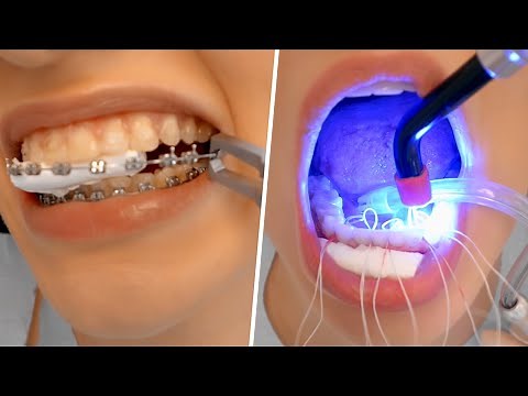 BRACES REMOVAL PROCESS - Satisfying