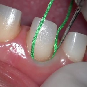 Placing retraction cord 🦷 . . . By • @dr.uchiyama #primarycord #toothpreparation #finalimpression #microdentistry #dentist #dental #microscopedentistry #microscope | Dentistry blog