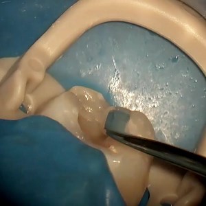 Direct restoration 醴✨ . . By @takahashi.dental #directrestoration #resin #compositerestoration #prosthodontist | Dentistry blog | Facebook