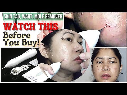 Beauty Mole Removal Sweep Spot Pen | Removal Of Warts, Moles, Etc. | Effective Skin Tag Remover!