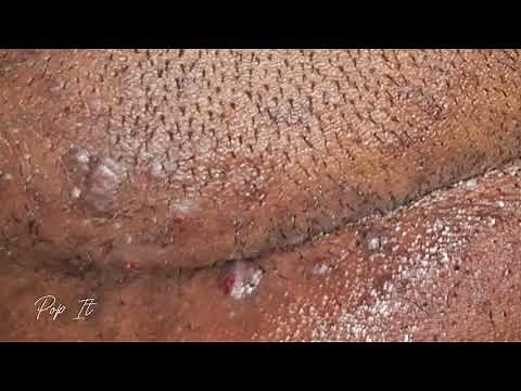 Satisfying Ingrown Hair Removal (Back of head) | Pt. 3