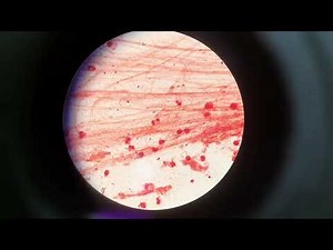 Gram positive bacteria | Diphtheroids in Gram Staining of Sputum Microscopy