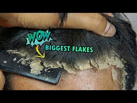 Wow! BIGGEST Dandruff Flakes Scratching Satisfying Front View At Home #489
