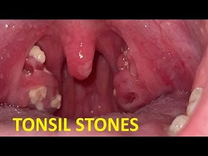 HOW TO GET RID OF TONSIL STONES STEP BY STEP GUIDE FOR BEGINNERS