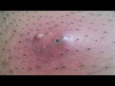 HOW TO GET RID OF INGROWN HAIRS FAST AND EASY