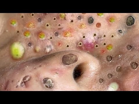 Relax Every Day With Loan Nguyen Spa | Acne Treatment Pimple Popping #50