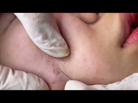 cysts and blackheads this week , blackheads , cystic acne extraction , big blackheads #001