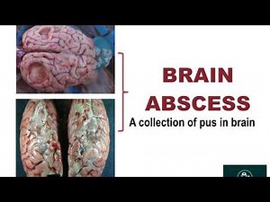 Brain Abscess