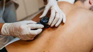 Credeva fosse un morso d'insetto, era un tumore al quarto stadio: diagnosi shock per un uomo