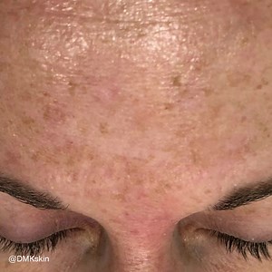 18 reactions · 17 shares | PIGMENTATION Say goodbye to pigmentation troubles with DMK! ✨ Our advanced solutions are specifically designed to target and correct uneven skin tone, giving you a brighter and more radiant complexion. Let DMK be your secret weapon in the battle against pigmentation. Discover the confidence that comes with flawless skin today and book an appointment at your local DMK clinic!  @sugarandstoneskin #dmkskin #dmkrevision | DMK Australia & New Zealand | Facebook