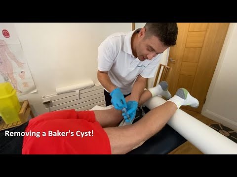 Baker's Cyst Aspiration