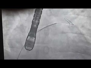 PFO Closure by Amplatz device Tricks