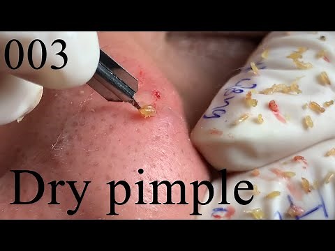 Acne Treatment Huong Beauty Under The Skin #