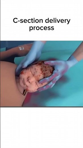 C- section delivery