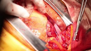Open Heart Surgery, human beating heart.