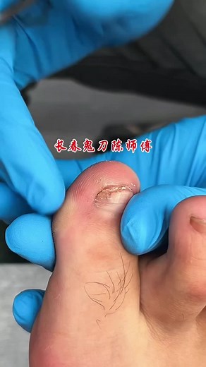 វីដេអូ​របស់ Foot Care (@footcare007) ជាមួយ original sound - Foot Care
