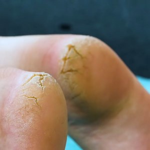 425K views · 926 reactions | How to Transform Cracked Heels for Sandal Season | Simple ideas | Facebook