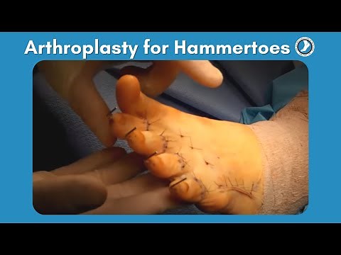 Arthroplasty Procedure for Hammertoes
