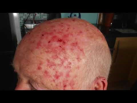 Using Efudix for actinic keratoses