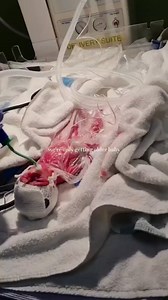 Micro preemie | Dr Karan
