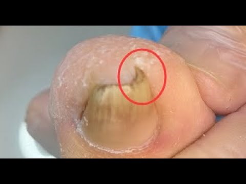 Step by step how to remove ingrown toenail