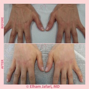  Hand rejuvenation with filler injection  ____  Procedure: Filler...