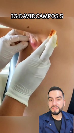 Absceso en la axila: Causas y Tratamientos Efectivos