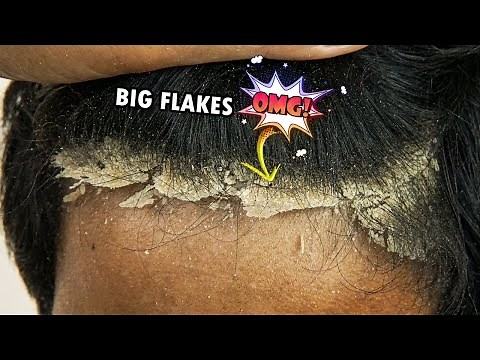 OMG! Extreme Dandruff Removal Big Flakes Satisfying #512
