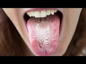 Oral Thrush (Oral Candidiasis); Causes, Symptoms & Treatment