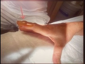 Paronychia, Abscess Drainage. A didactic video for young surgeons