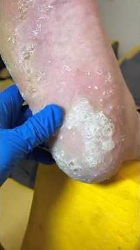 Severe Plantar Warts on the Foot? Gentle & Safe Care Process (No Pain)#Plantar Wart #callusremoval