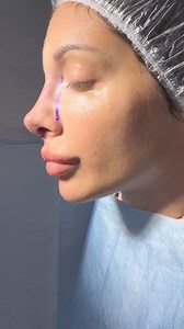 17K views · 71 reactions | Risultato del naso凉 un sogno che si realizza dopo 15 anni di insicurezze勺 #love #instagram #asmr #fashion #photography #art #trendingreels #like #music #followers #viralvideo #follow #india #tiktok #fbreelsvideo | Greta Santarelli | Facebook