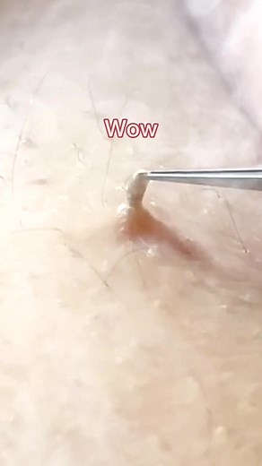 blackheadfighter on TikTok